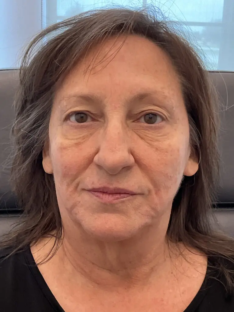 Facial Rejuvenation - before treatment