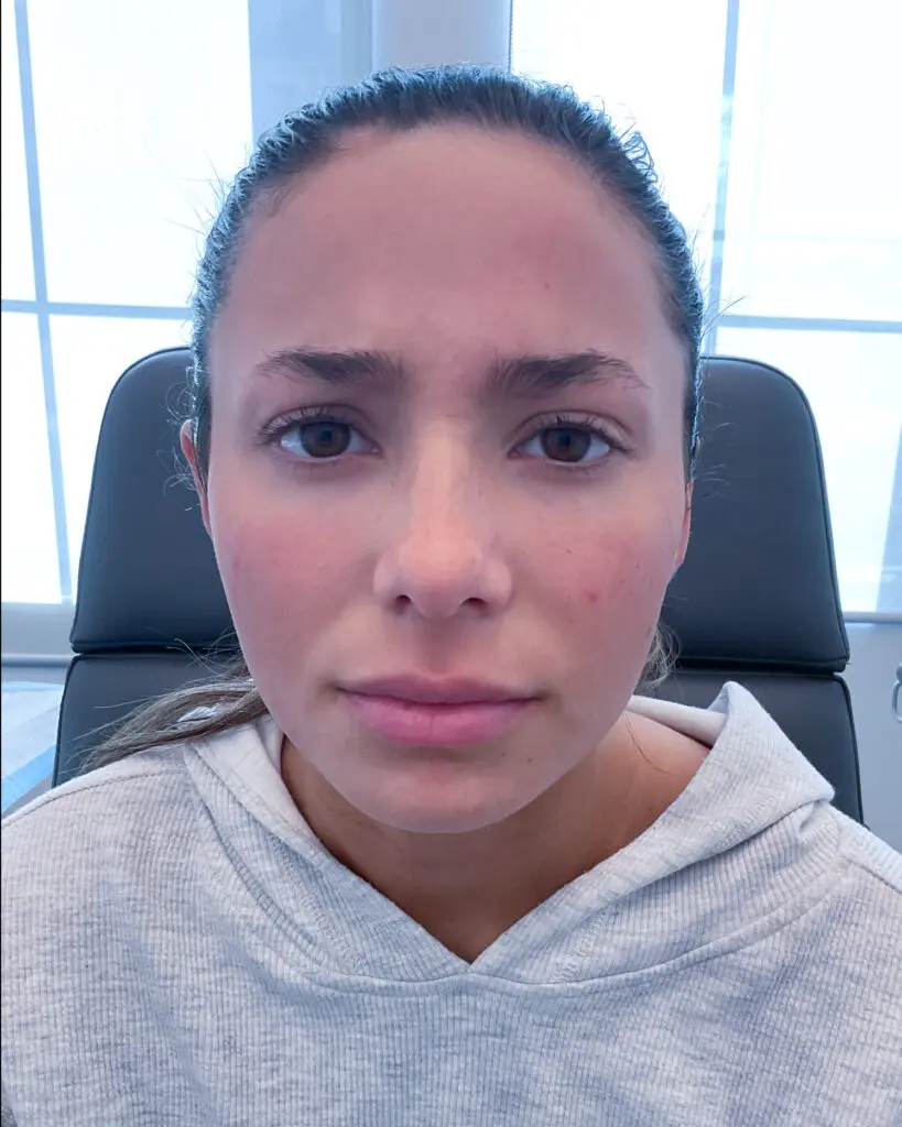 Botox - after treatment