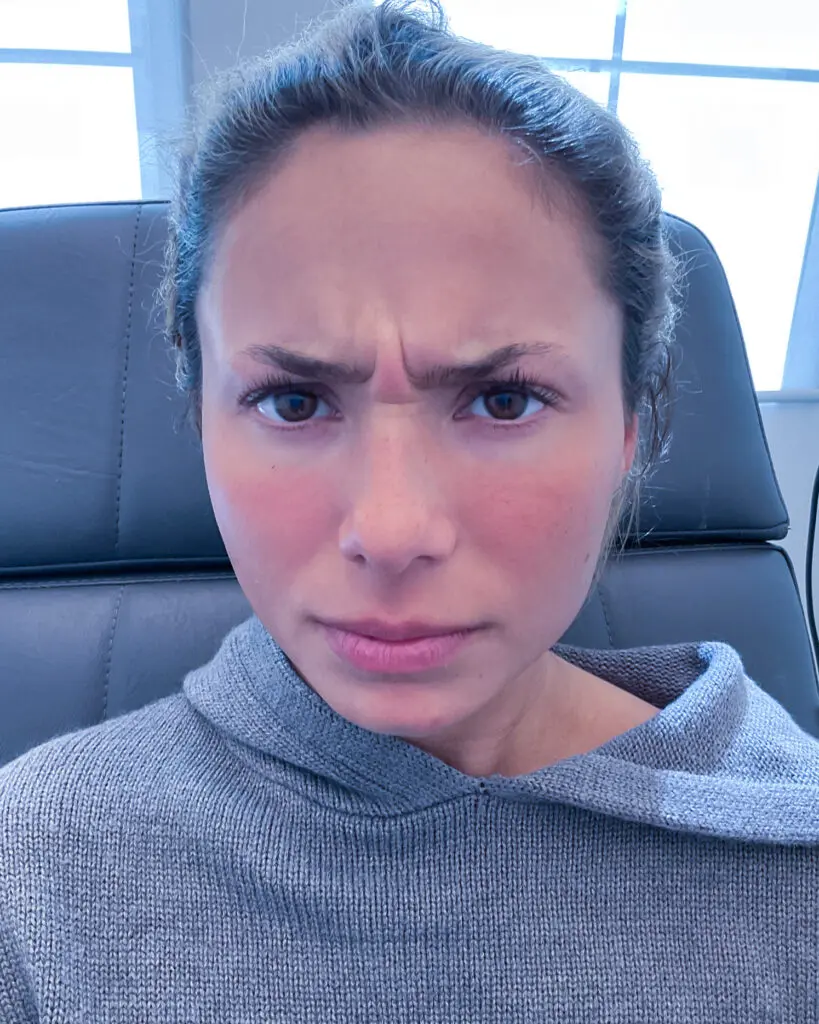 Botox - before treatment