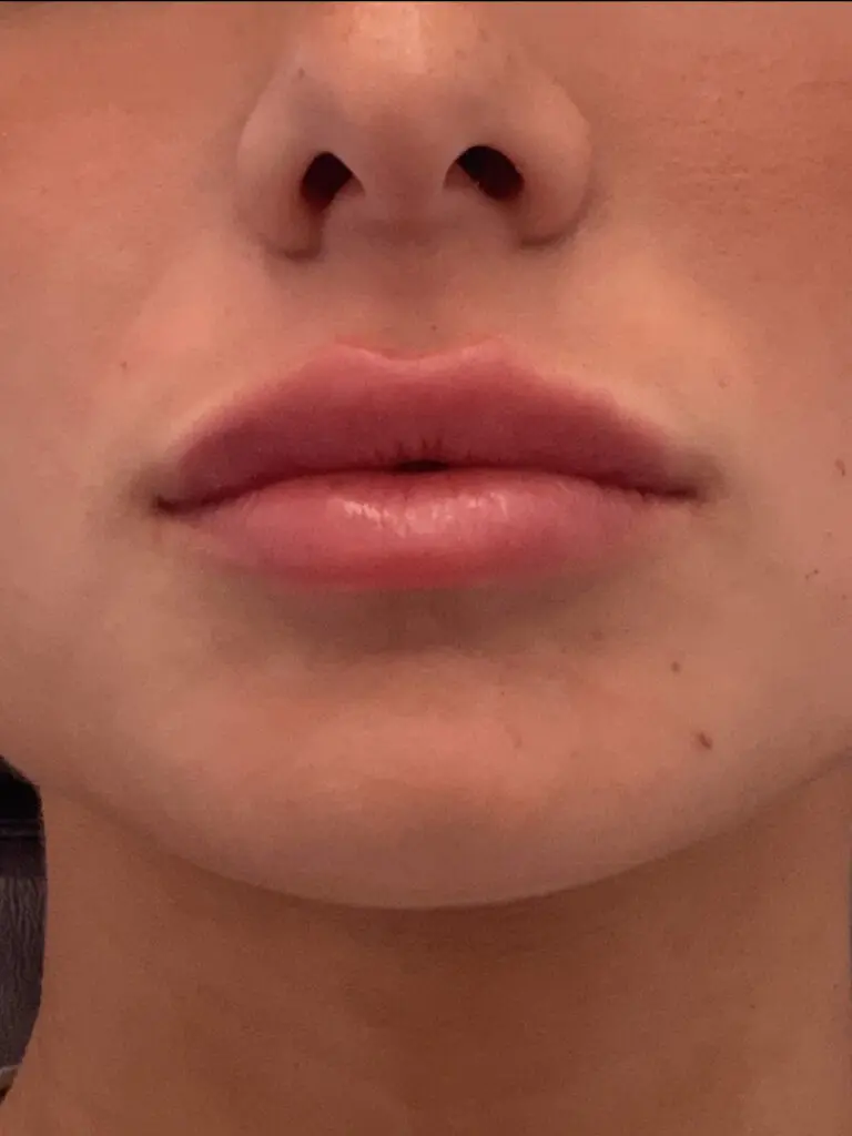 Lip Filler - after treatment