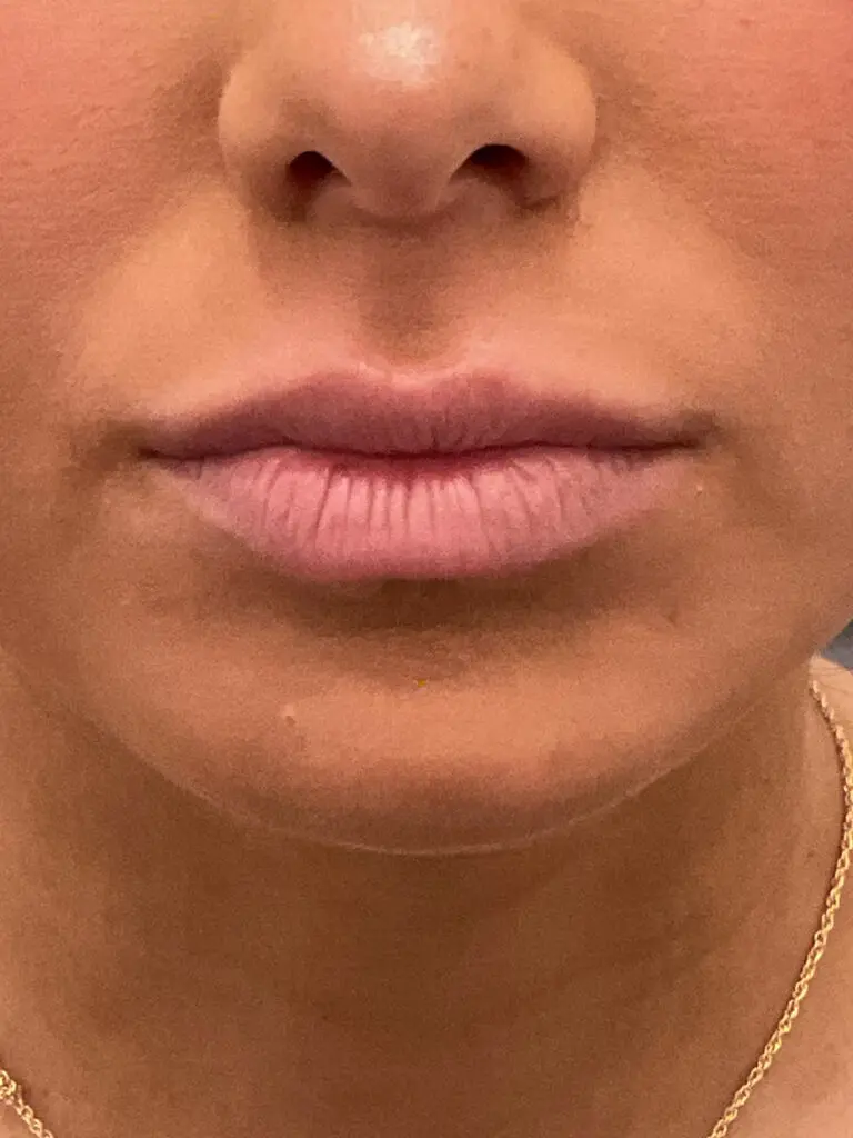 Lip Filler - before treatment