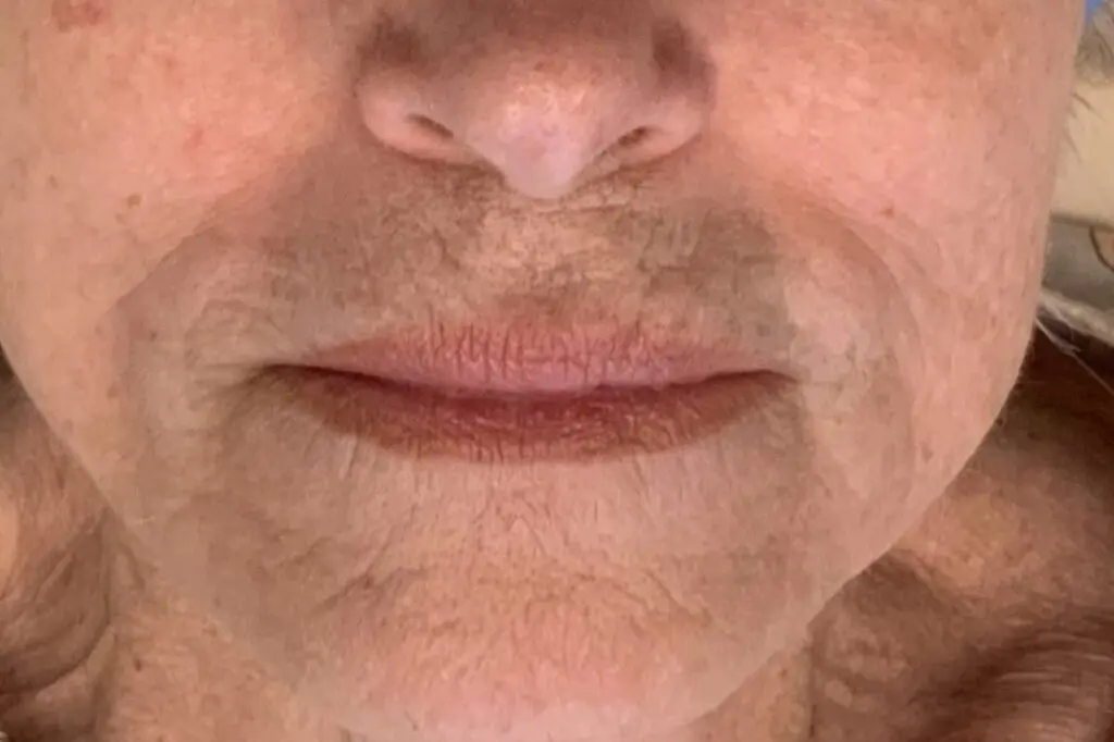 Skin Resurfacing - after treatment