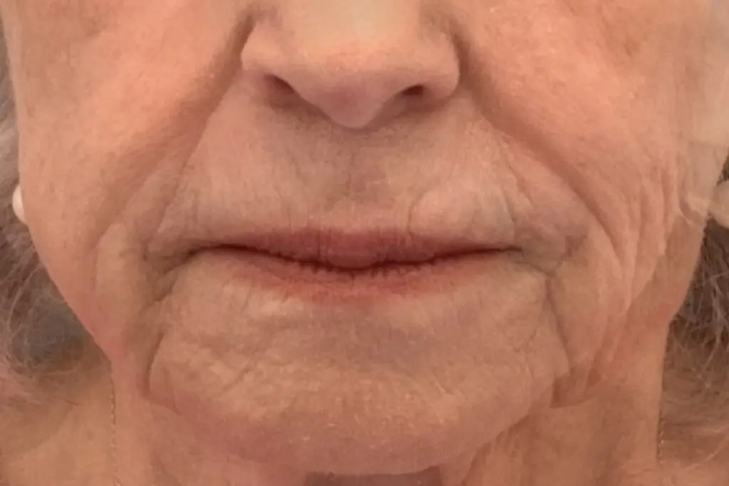 Skin Resurfacing - before treatment