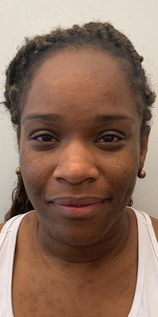 VI Peel - before treatment